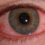 Болят глаза от сварки - первая помощь, что делать